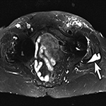 Inversion recovery imaging