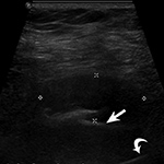 Pseudotumor on ultrasound