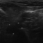 Pseudotumor on ultrasound