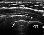 Ultrasound rotator cuff evaluation