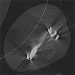 Suboptimal dual energy CT
