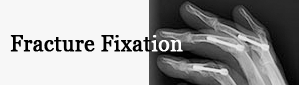 Fracture Fixation